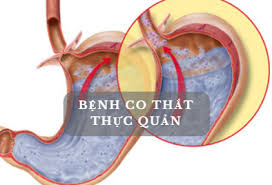 Co thắt thực quản - Hình ảnh minh họa